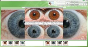 12MP Iriscopio