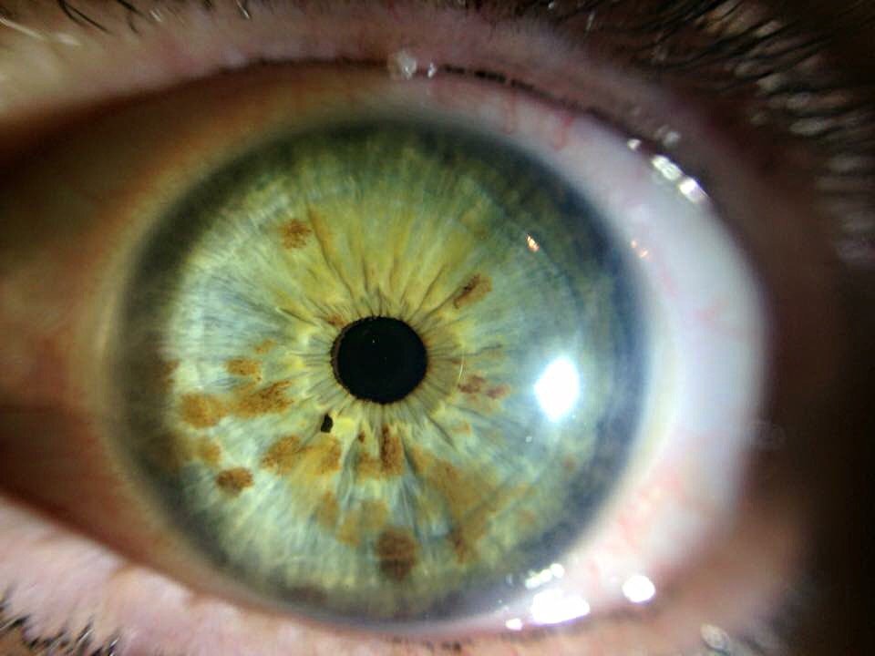 12MP Iriscopio