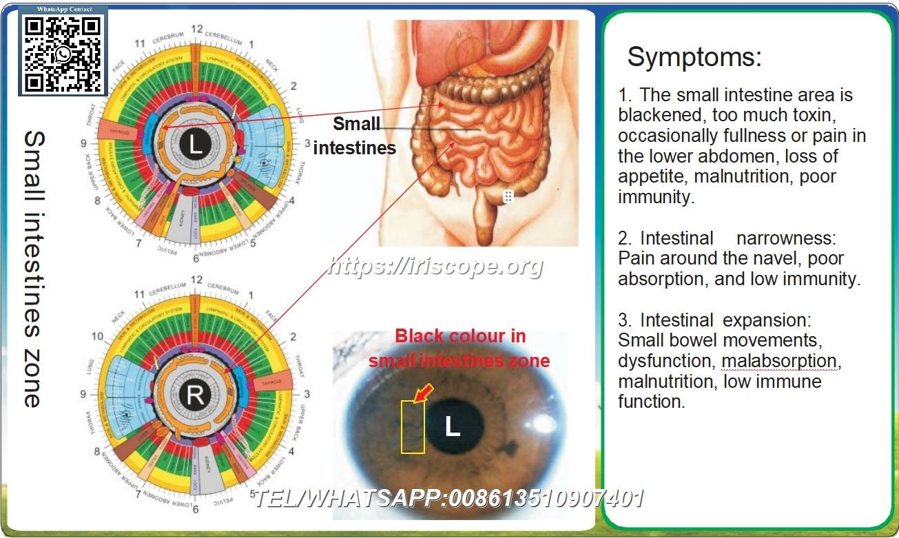 Capítulo 8: Zona de reflexología iridológica y los ocho sistemas corporales 8.1 Sistema Digestivo – Caso 3