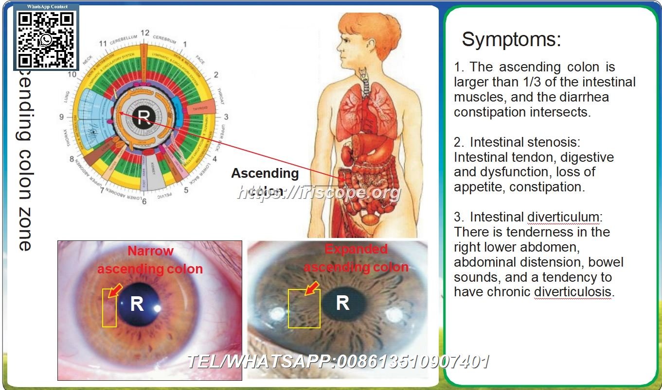 8.1 Iridología: Colon Ascendente Estrecho y Colon Ascendente Expandido – Caso 4