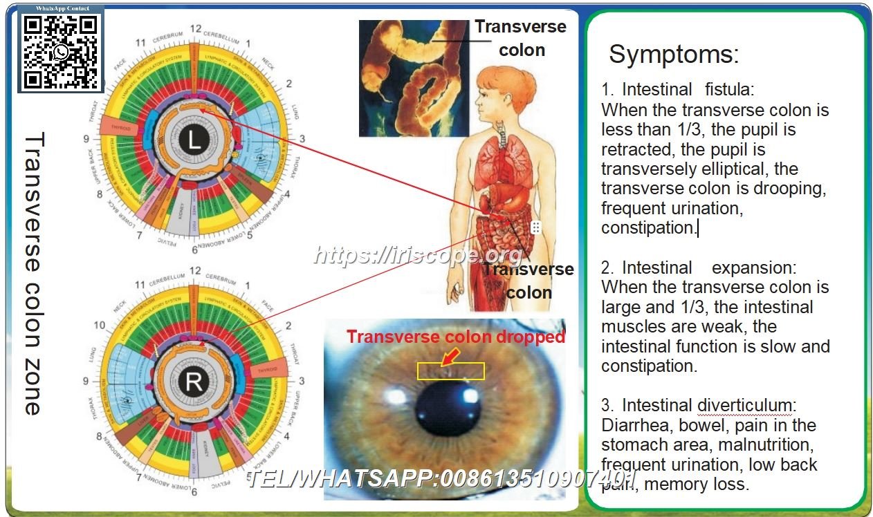 8.1 Iridología: Colon Transverso y Ptosis Colonica