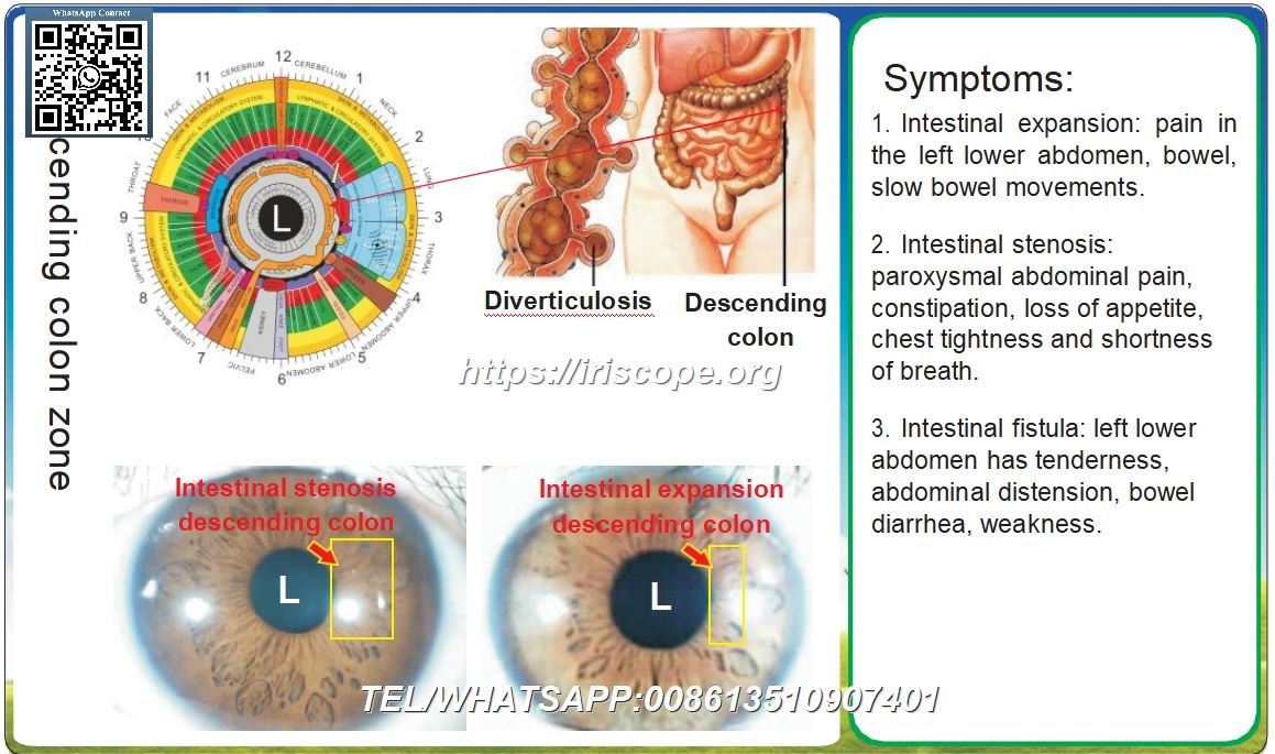 Iridología y Patologías del Colon Descendente: Un Enfoque Clínico Integral